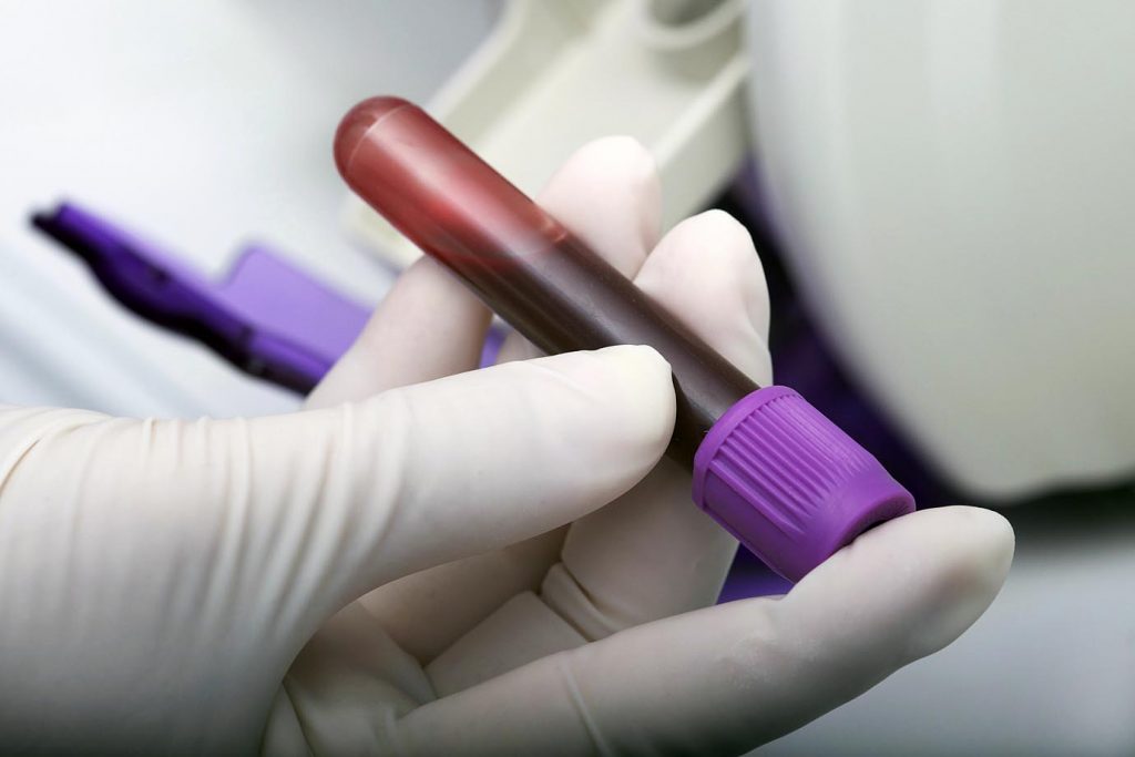 Exame de sangue próstata